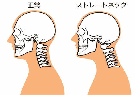 ストレートネック　/福島市/整体